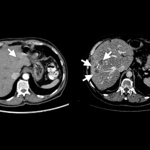 Two CT scans of the abdomen from a top-down view. There are arrows pointing to blotches, representing tumors, on the scans.